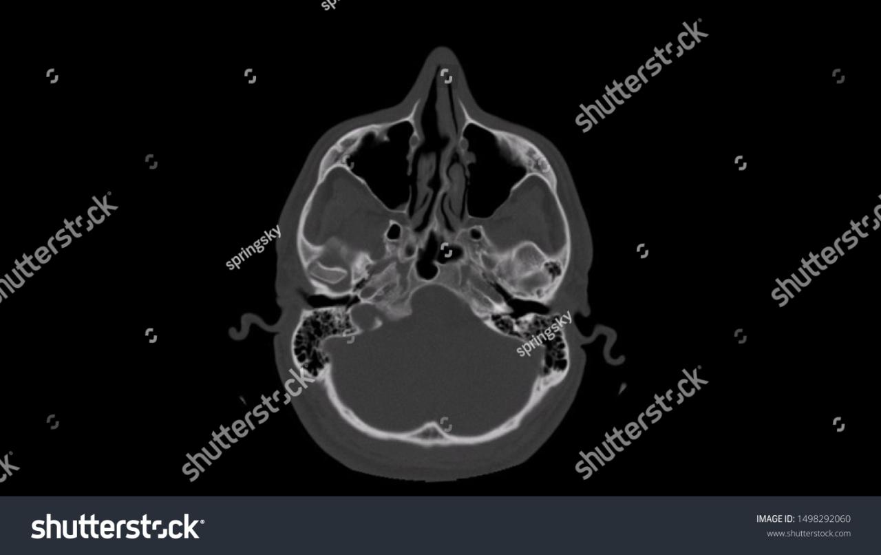 Ct Scan Human Paranasal Sinuses Many Stock Photo 1317052820 | Shutterstock How Does 5G Technology Change Internet Connectivity